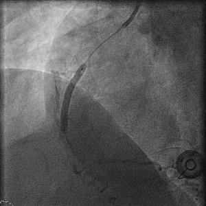 HC 11: Obstructief en non-obstructief coronairlijden